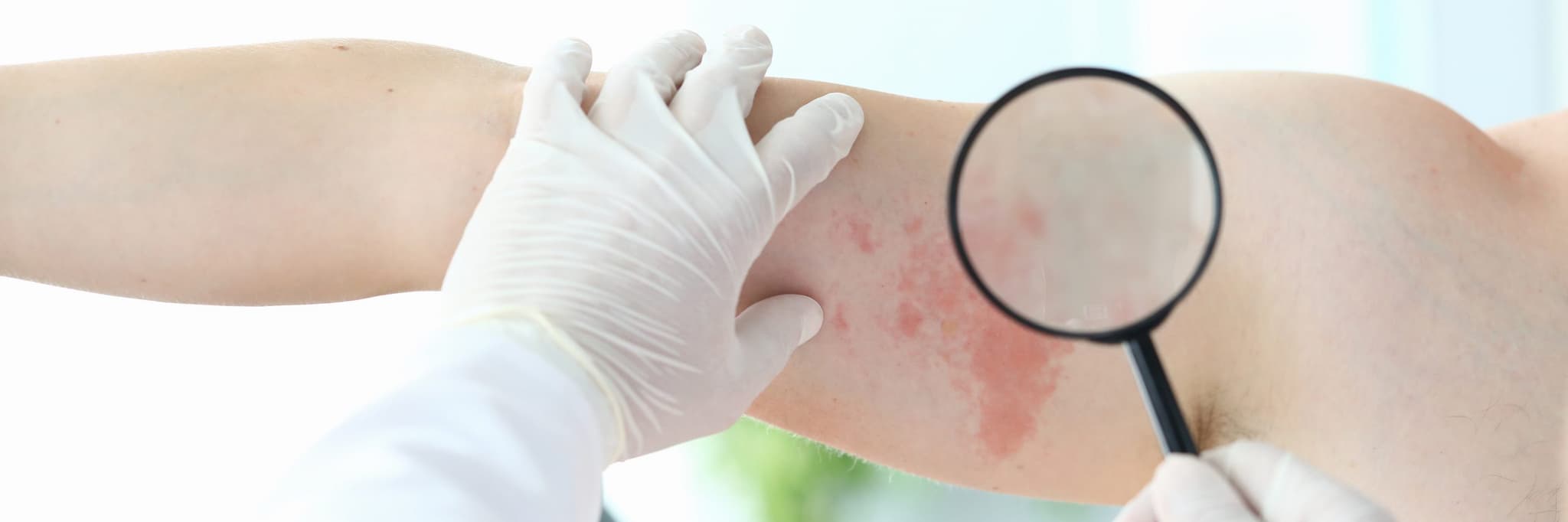 Gloved doctor looking at rash with magnifying glass