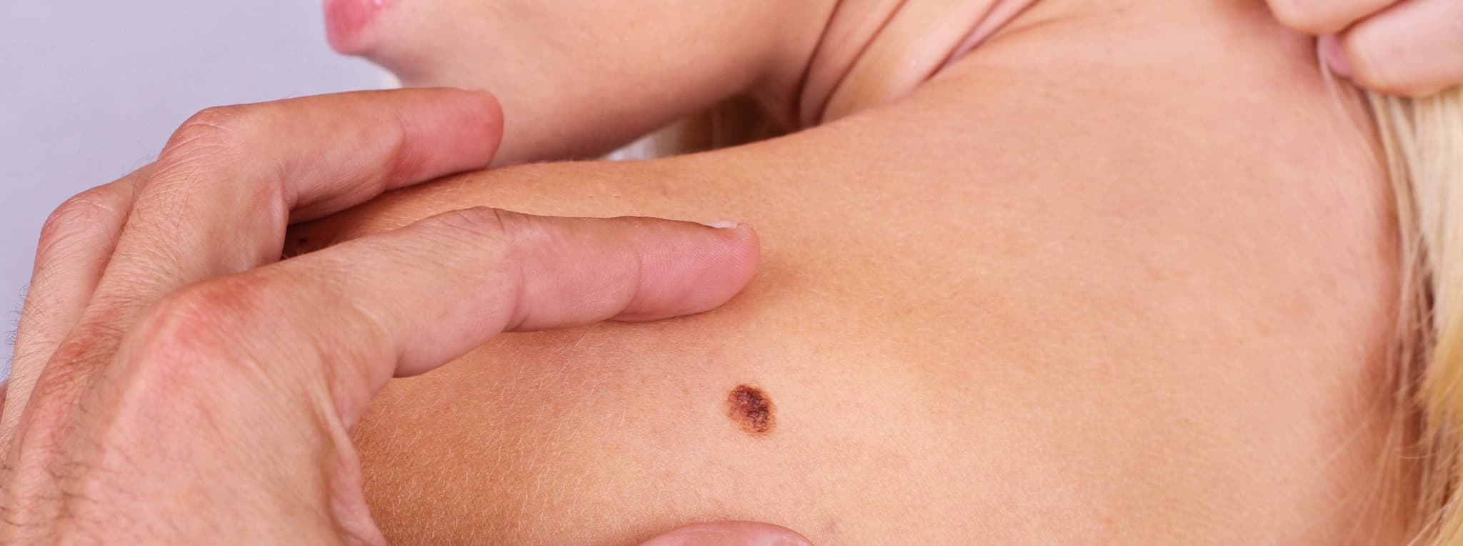 Picture of woman with mole on shoulder being examined