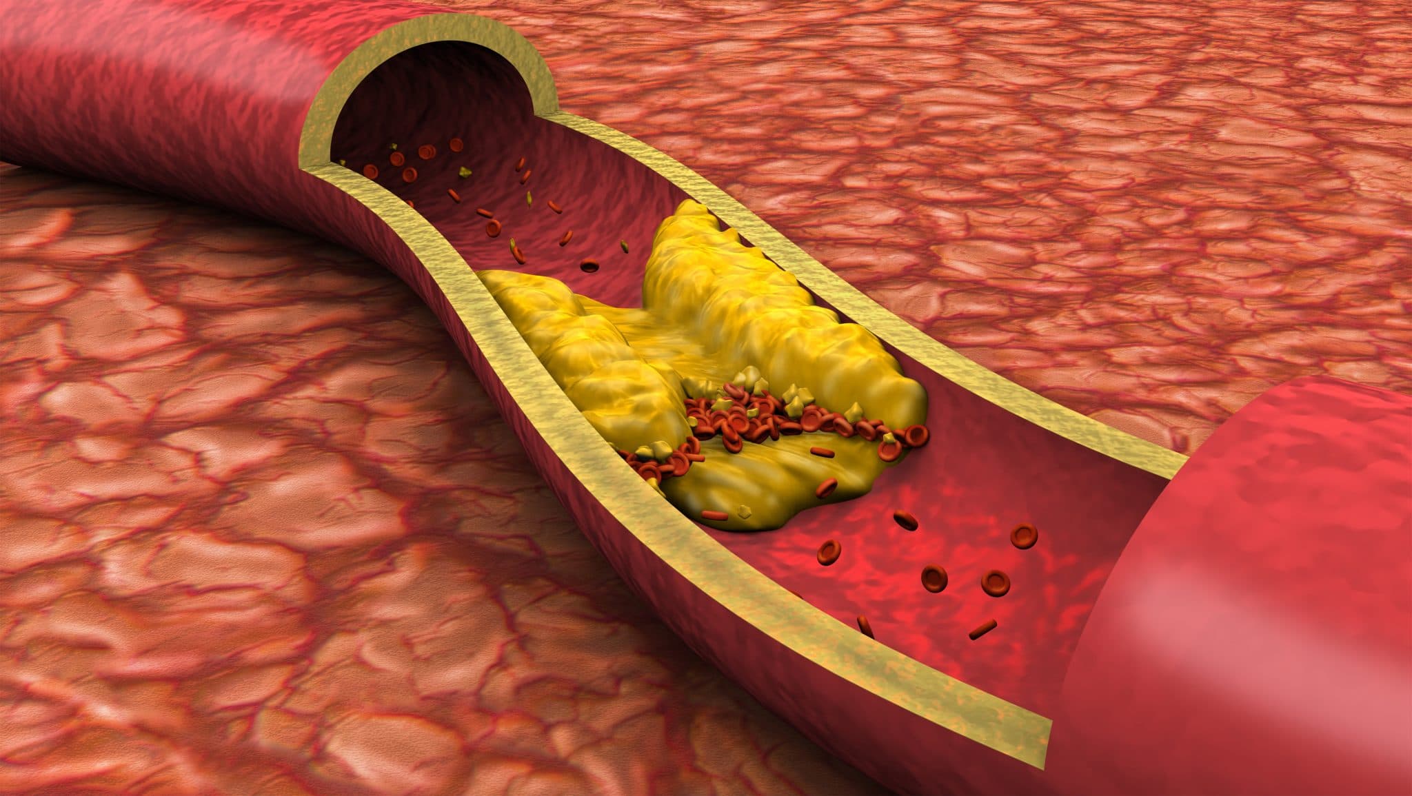 Picture of Clogged artery low angled view shown with a cut out section displaying fat deposits and a formed clot. High quality rendering with original hand painted textures and global illumination with great detail.
