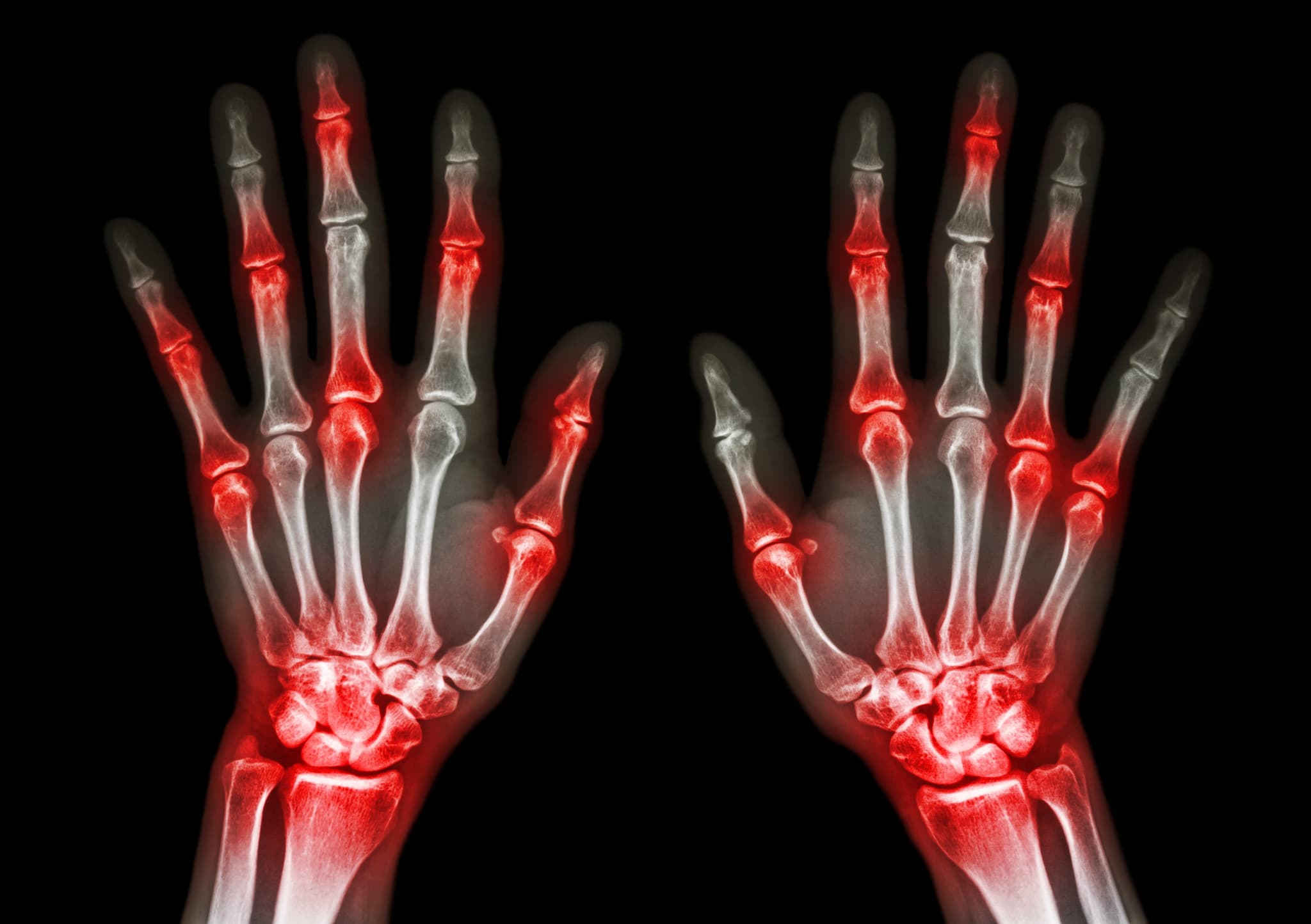 Picture of film x-ray both human's hands and arthritis at multiple joint (Gout,Rheumatoid)